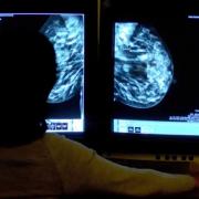 Breast cancer screening remains below pre-Covid levels
